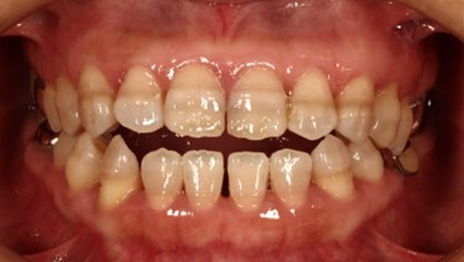 受け口、開咬、デンタルインプラントとのコンビネーション治療BEFORE3