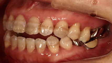 受け口、開咬、デンタルインプラントとのコンビネーション治療BEFORE4