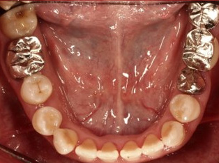 受け口、開咬、デンタルインプラントとのコンビネーション治療BEFORE5