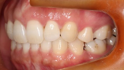 出っ歯、側貌改善、ガミースマイル治療AFTER4