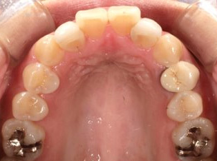 出っ歯、側貌改善、ガミースマイル治療出っ歯、側貌改善、ガミースマイル治療BEFORE1