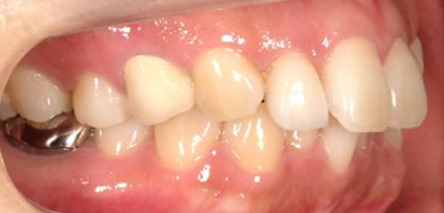 出っ歯、側貌改善、ガミースマイル治療BEFORE2