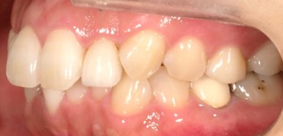 出っ歯、側貌改善、ガミースマイル治療BEFORE4