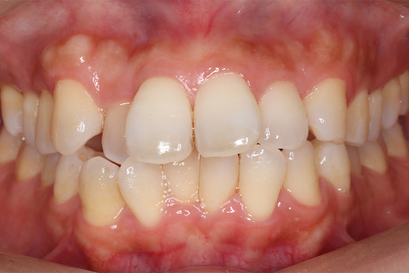 部分矯正の症例1・治療前