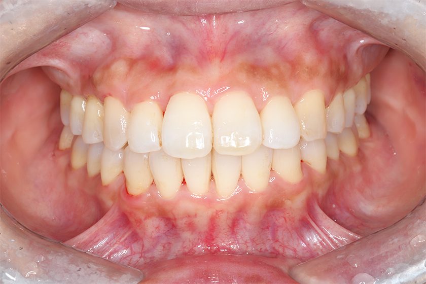 部分矯正の症例1・治療終了前
