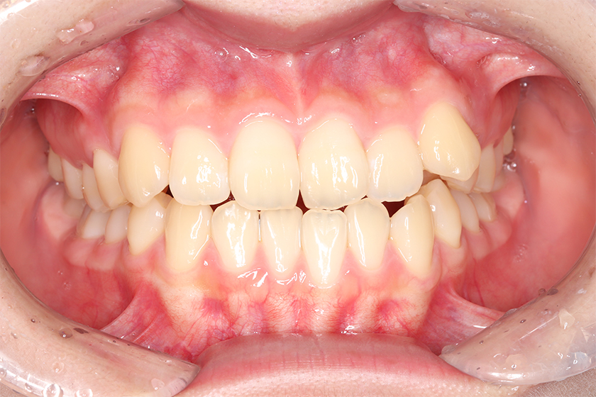 部分矯正の症例2・治療前