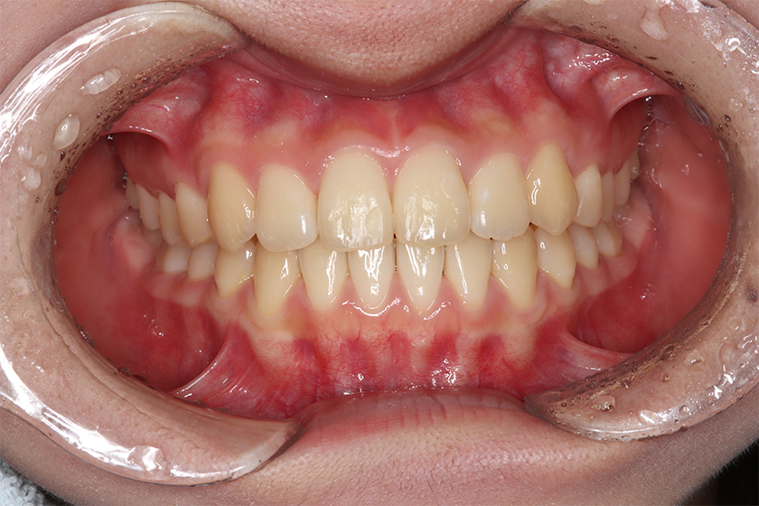 部分矯正の症例2・治療終了前