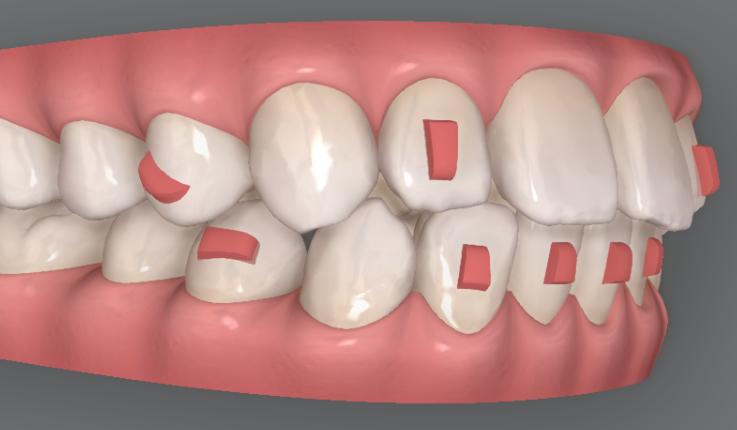 複雑な歯の移動を可能にする